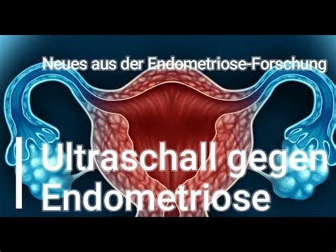 was kann man gegen endometriose tun